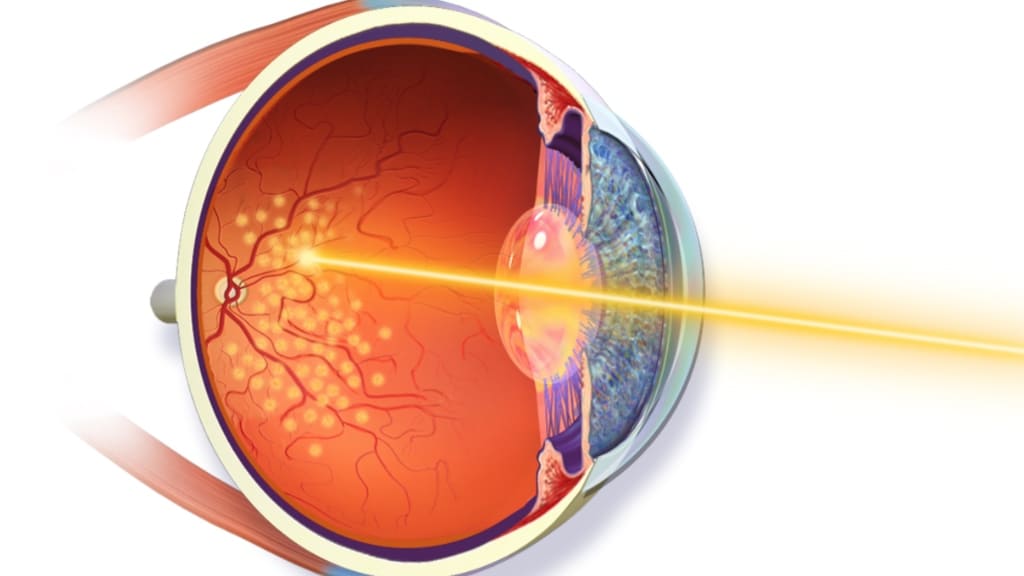 Laser quang đông võng mạc giúp kiểm soát xuất huyết và ngăn ngừa tân mạch