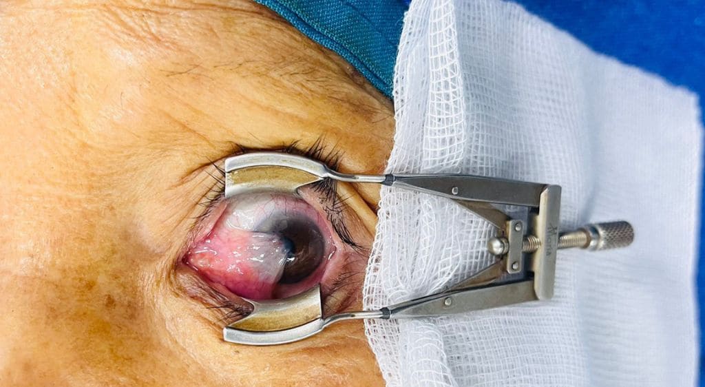 Mí mắt được cố định nhẹ nhàng bằng dụng cụ chuyên dụng