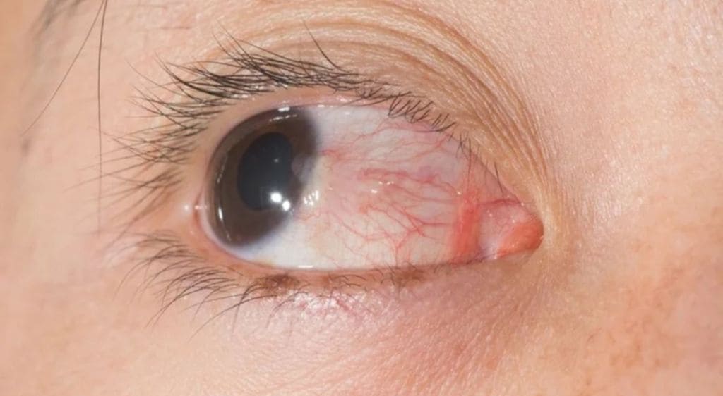 Mộng thịt có thể tái phát nếu không được chăm sóc đúng cách