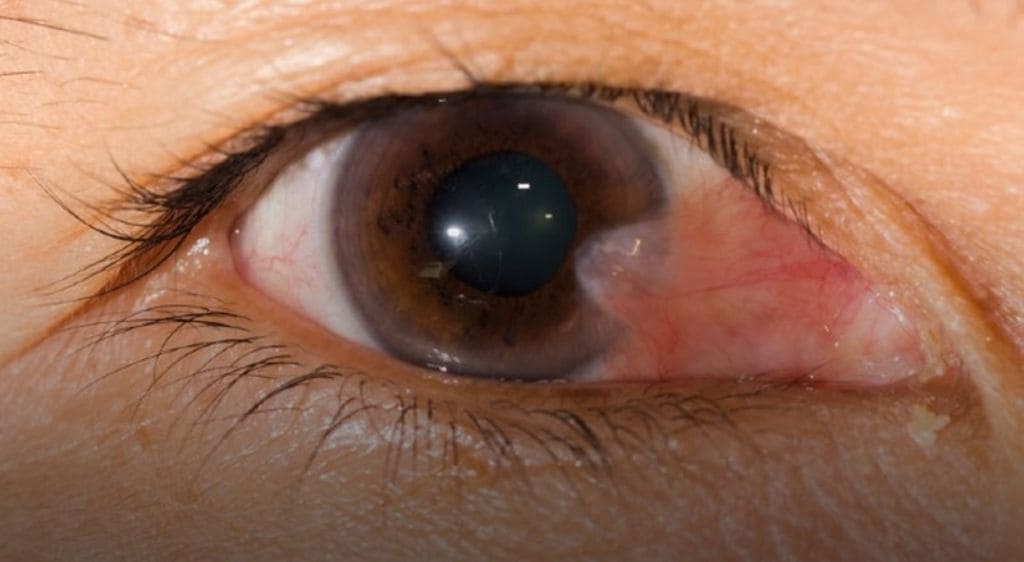 Mộng thịt gây mất thẩm mỹ và cản trở thị lực