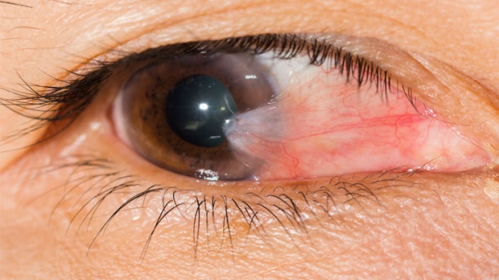 Mộng thịt là sự phát triển các mô xơ mạch trên phần trắng của mắt