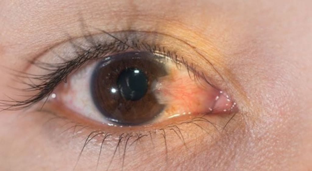 Mộng thịt ở mắt gây cản trở thị lực