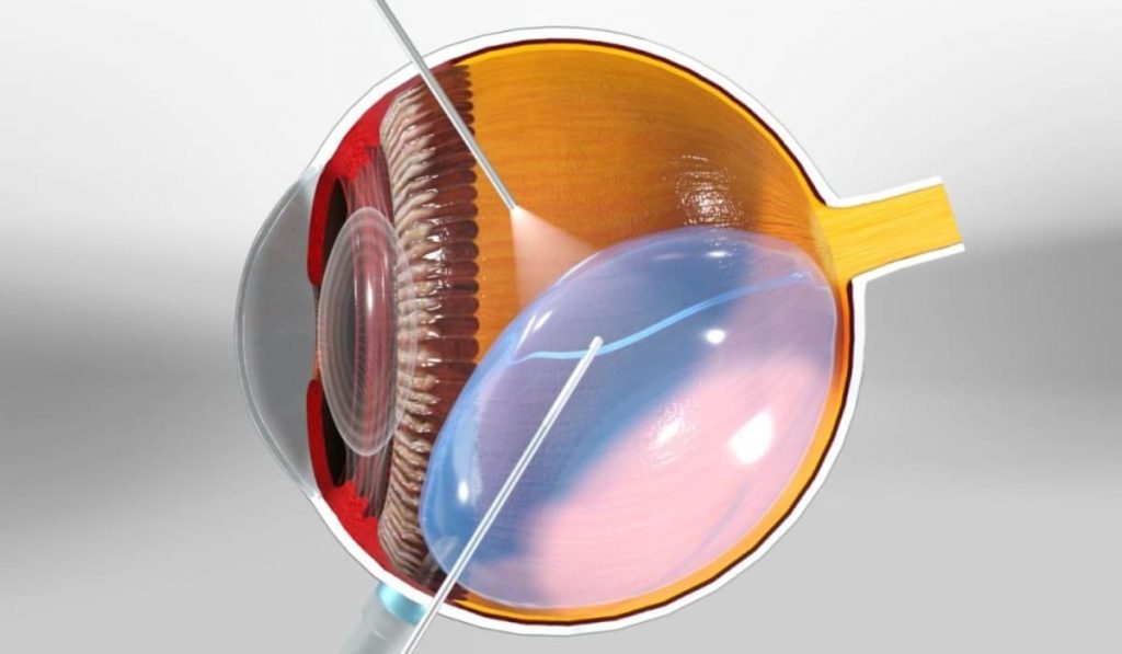 Phẫu thuật cắt dịch kính là kỹ thuật loại bỏ dịch kính để cải thiện thị lực