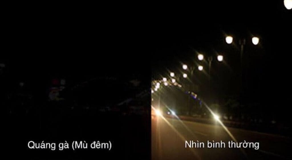 Quáng gà là biểu hiện sớm và điển hình nhất của viêm võng mạc sắc tố