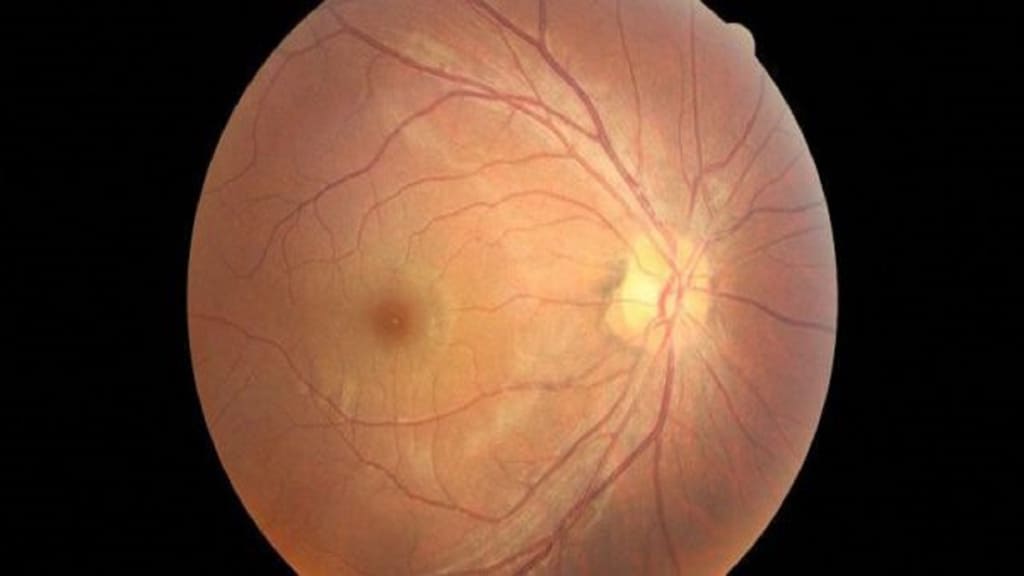 Tắc động mạch trung tâm võng mạc thường xảy ra cấp tính và tiến triển nhanh