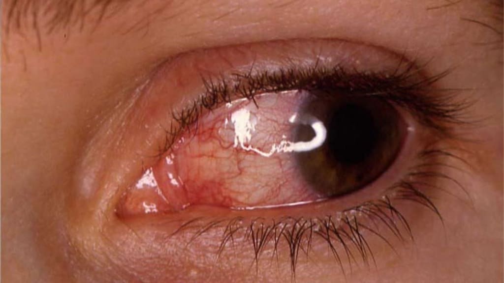 Tắc tĩnh mạch trung tâm võng mạc gây xuất huyết, phù nề và tổn thương võng mạc