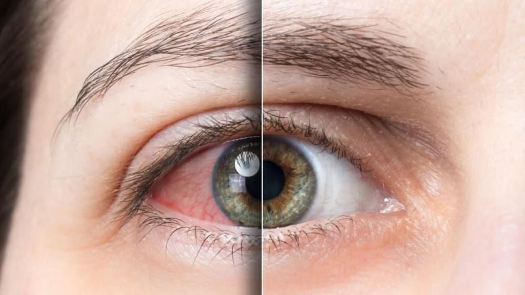 Tăng nhãn áp là một trong những nguyên nhân chính dẫn đến tắc tĩnh mạch trung tâm võng mạc