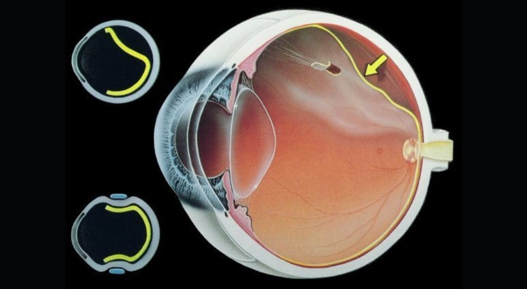 Teo võng mạc là một nhóm bệnh lý nghiêm trọng gây tổn thương các tế bào võng mạc
