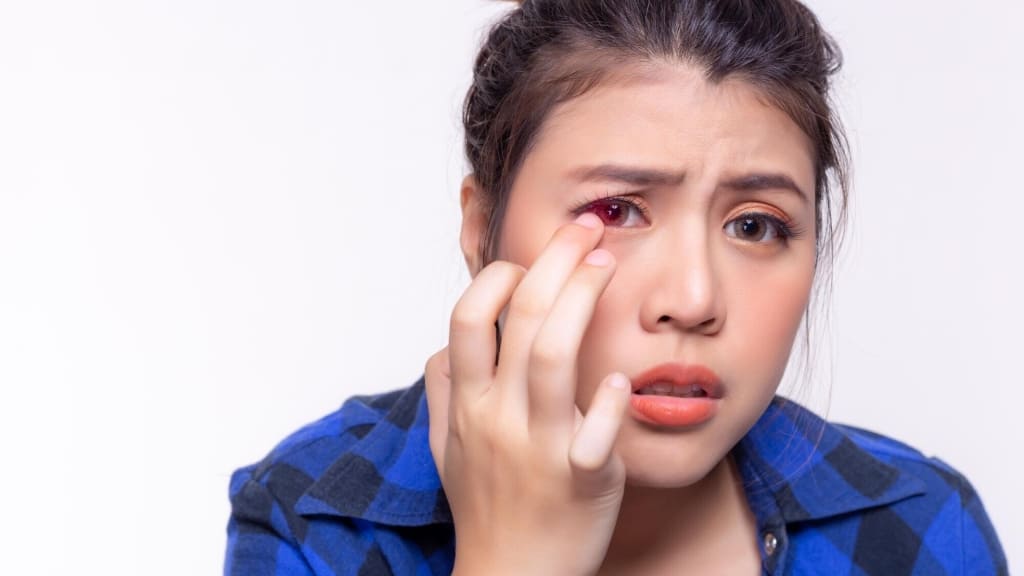 Thoái hóa điểm vàng ở người trẻ chủ yếu do loạn dưỡng bẩm sinh, gây mờ thị lực trung tâm