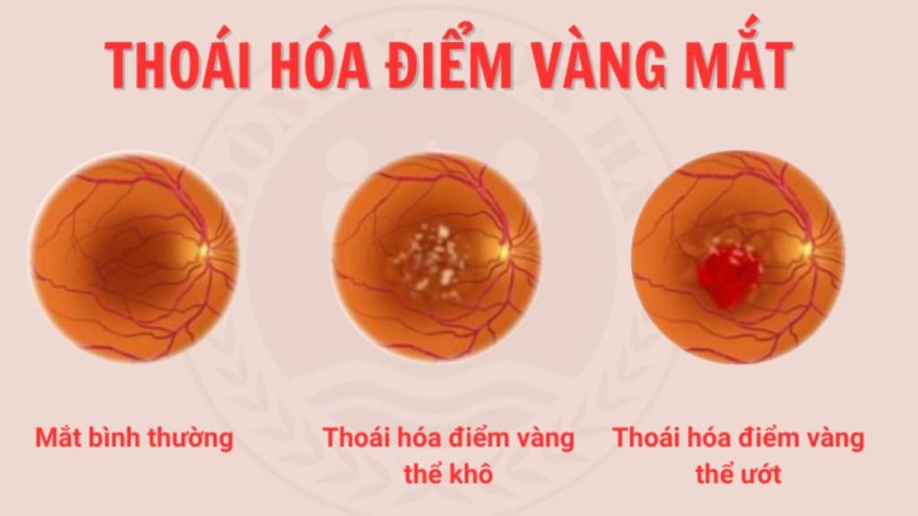 Thoái hoá điểm vàng thể khô và thoái hoá điểm vàng thể ướt