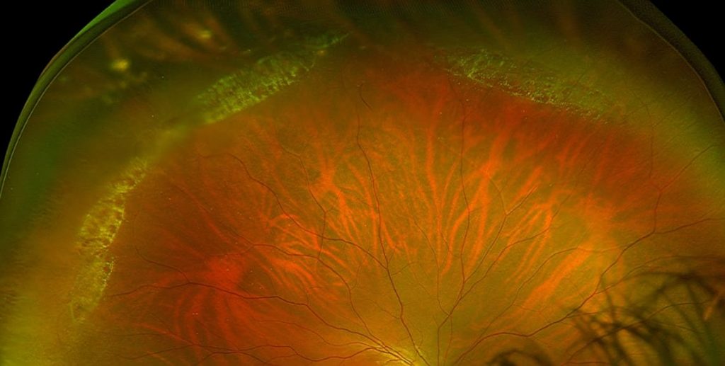 Thoái hoá võng mạc chu biên là vùng rìa ngoài võng mạc bị mỏng, tổn thương theo thời gian