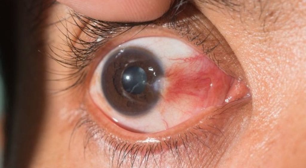 Thời gian mổ mộng thịt không chỉ từ 30 - 45 phút, không cần nằm viện