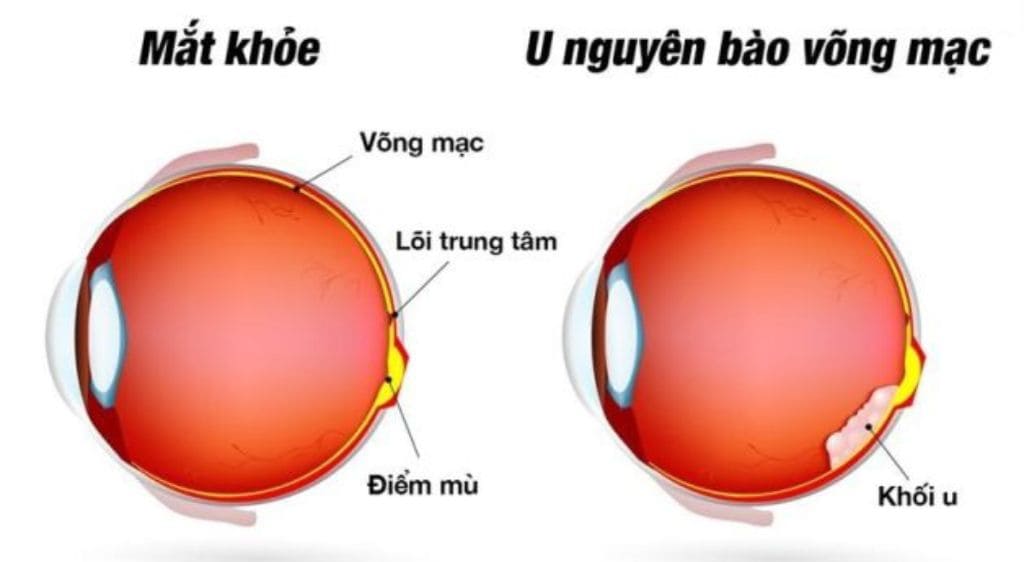 U nguyên bào võng mạc là một bệnh lý ung thư xuất hiện chủ yếu ở trẻ em