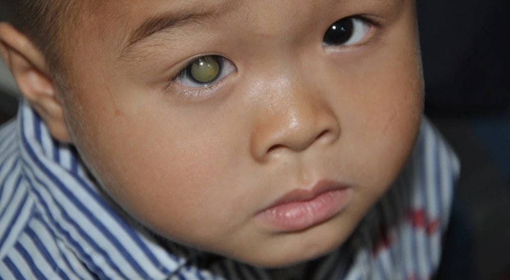 Ung thư võng mạc ở trẻ em có thể gây mù lòa và di căn lên não nếu không được chữa trị sớm