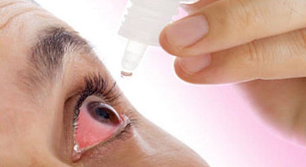 Việc dùng thuốc nhỏ mắt trị mộng thịt giúp giảm tình trạng viêm, đỏ mắt