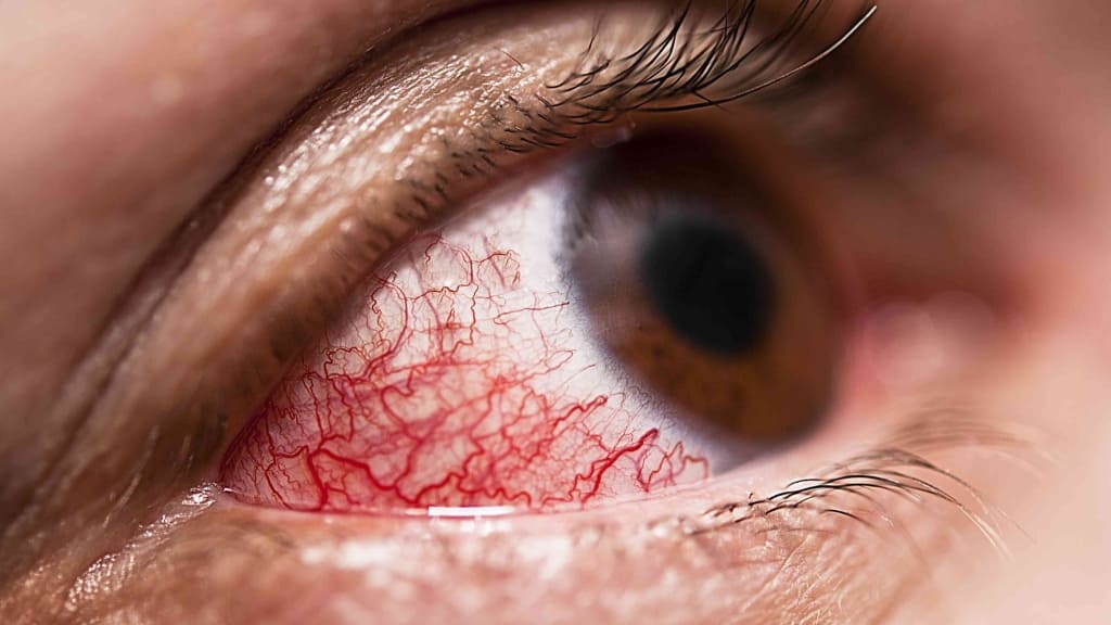 Viêm mạch máu mắt là một trong những nguyên nhân dẫn đến tắc động mạch trung tâm võng mạc