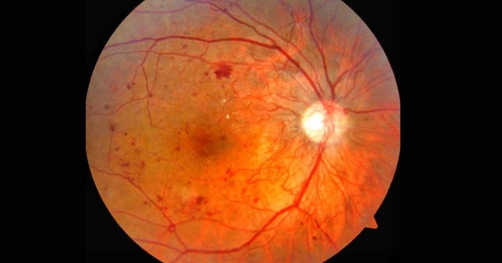 Võng mạc của bệnh nhân nhân gặp biến chứng do đái tháo đường xuất hiện nhiều điểm xuất huyết