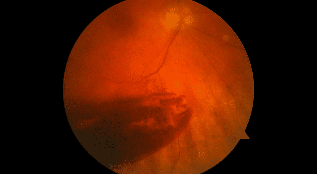 Xuất huyết dịch kính là một biến chứng nguy hiểm do xuất huyết võng mạc gây ra