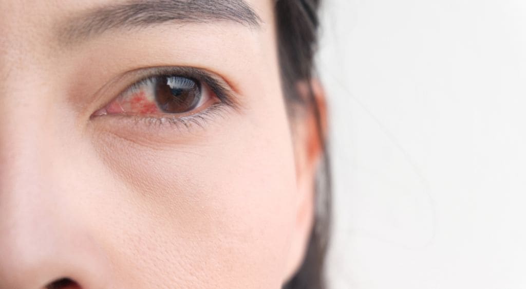 Xuất huyết võng mạc nhẹ có thể tự tiêu