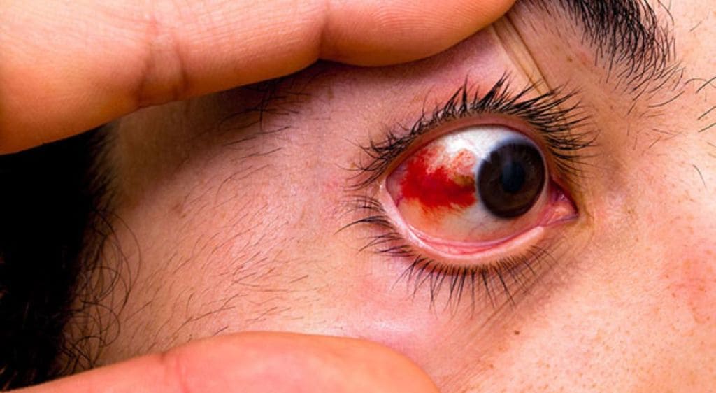 Xuất huyết võng mạc rất nguy hiểm nếu không điều trị kịp thời