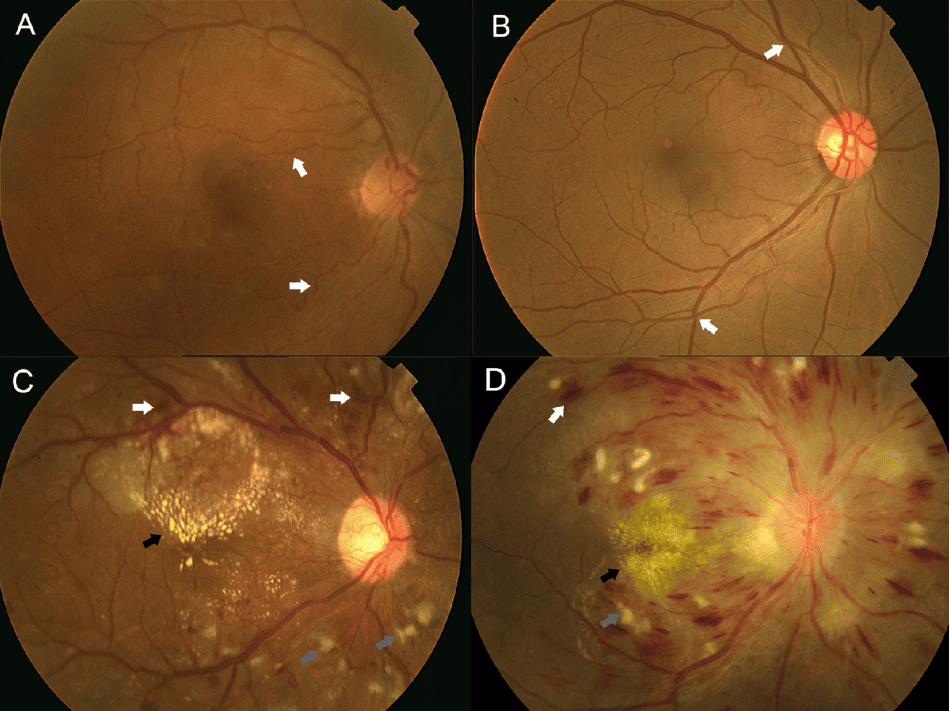 4 giai đoạn Keith–Wagener–Barker đánh giá mức độ nghiêm trọng của bệnh võng mạc tăng huyết áp