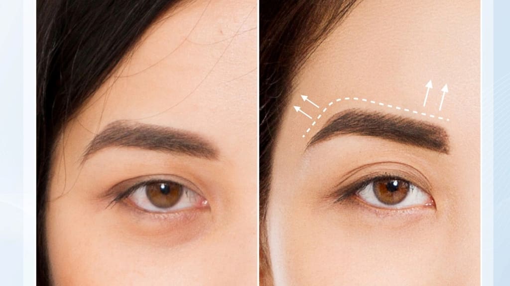 Bác sĩ cần tính toán tạo hình và khâu mí chính xác