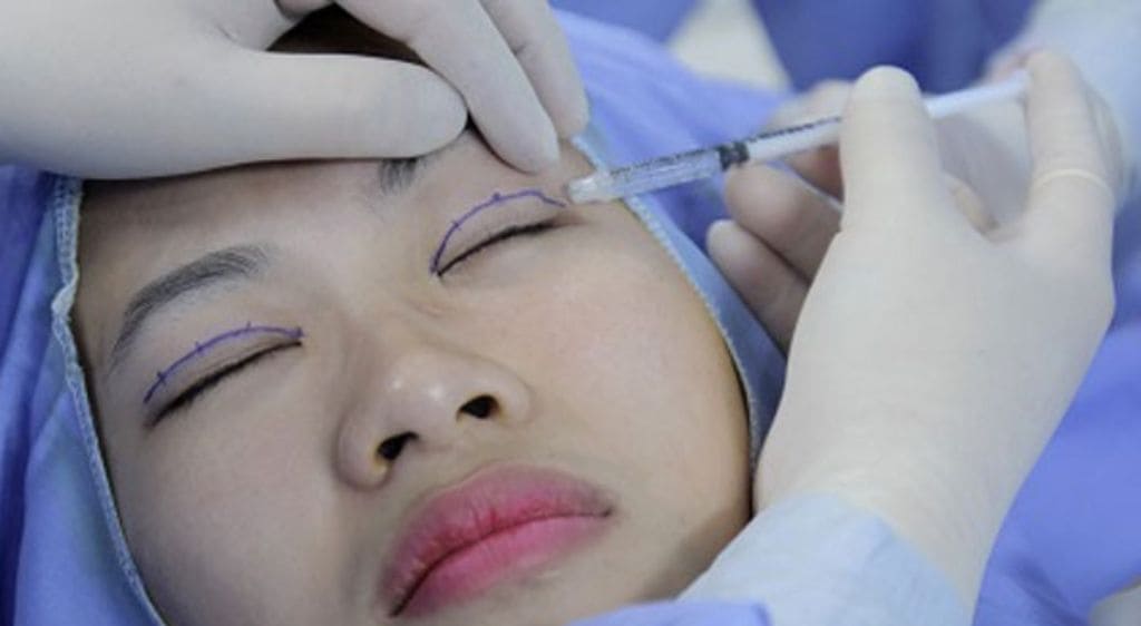 Bác sĩ đang tiến hành đo và vẽ tỷ lệ của nếp mí trước khi phẫu thuật