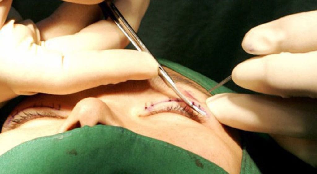 Bác sĩ sử dụng chỉ thẩm mỹ chuyên dụng để khâu tạo hình nếp mí mắt