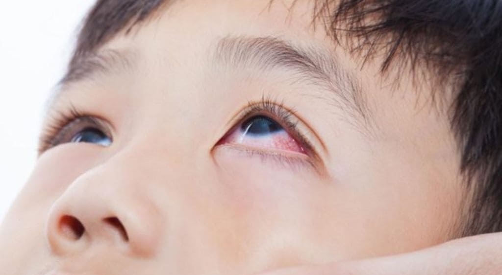 Bé bị bạn chọc tay vào mắt có thể gây tổn thương giác mạc
