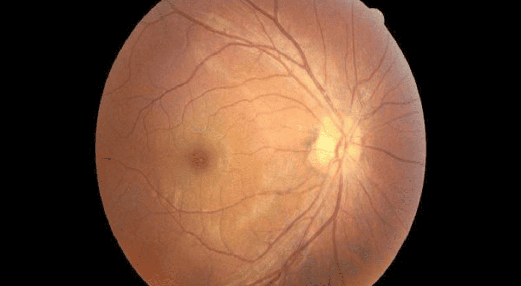 Bệnh hắc võng mạc trung tâm thanh dịch là một rối loạn tại vùng hoàng điểm