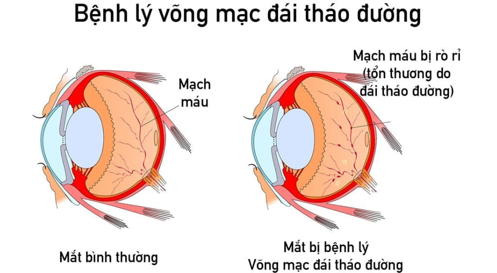 Bệnh lý võng mạc tiểu đường là một trong những nguyên nhân dẫn đến xuất huyết đáy mắt