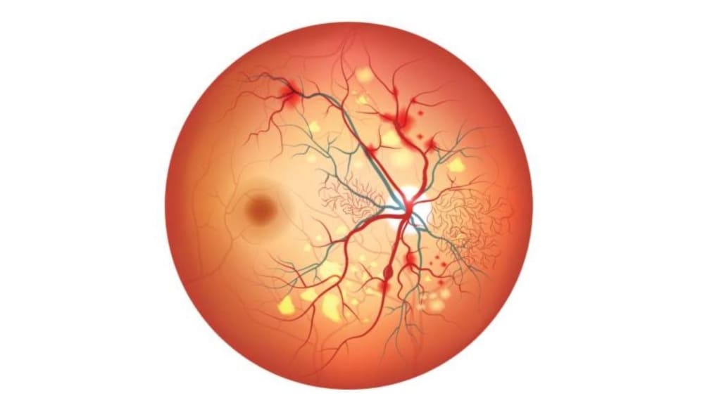 Bệnh võng mạc tăng huyết áp gây tổn thương mạch máu và phù nề võng mạc