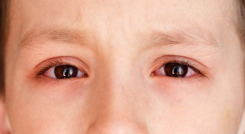 Bị móng tay chọc vào mắt có thể khiến trầy xước giác mạc gây cộm, chảy nước mắt,...