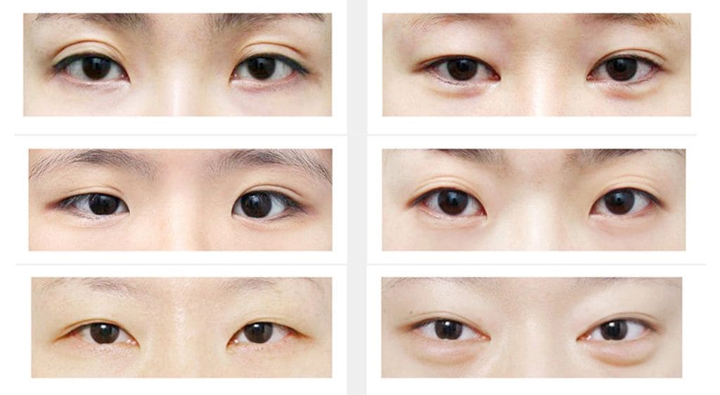 Cắt mắt hai mí Hàn Quốc giúp đôi mắt trở nên có hồn hơn