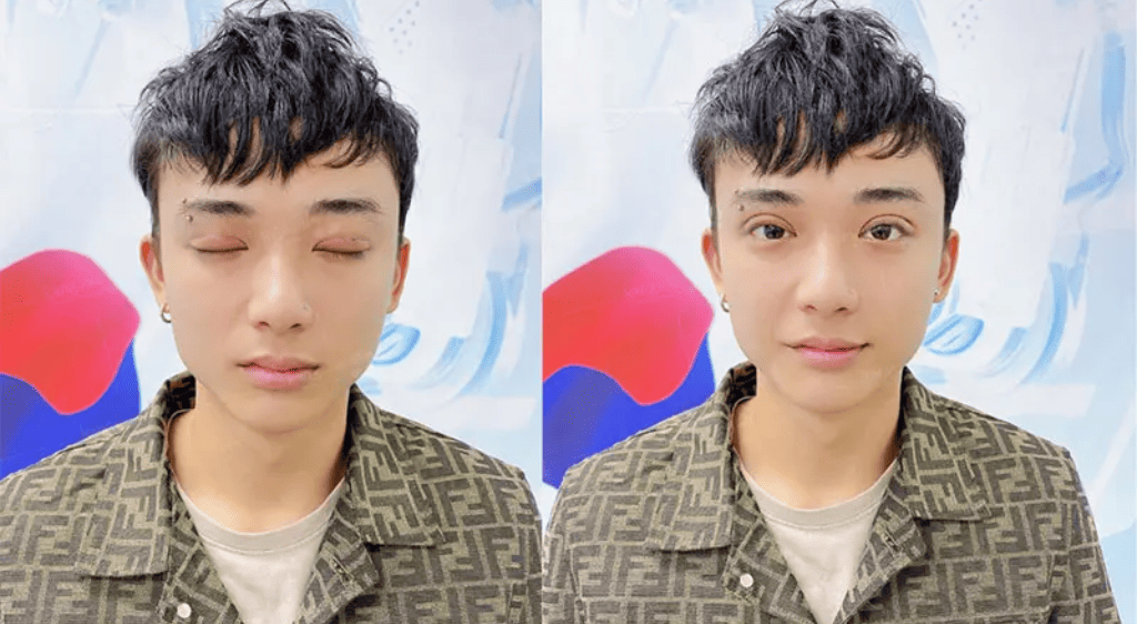 Cắt mí nam khác với nữ ở cả mục tiêu thẩm mỹ và cấu trúc giải phẫu