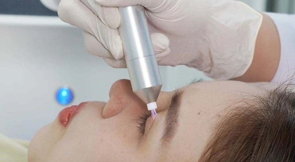 Cắt mí Plasma giảm sưng đau và hồi phục nhanh chóng