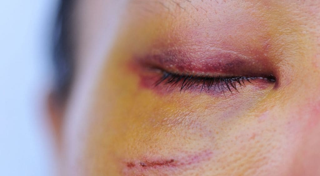 Chấn thương va đập vùng mắt là một trong các nguyên nhân dẫn đến đau mắt đỏ chảy máu