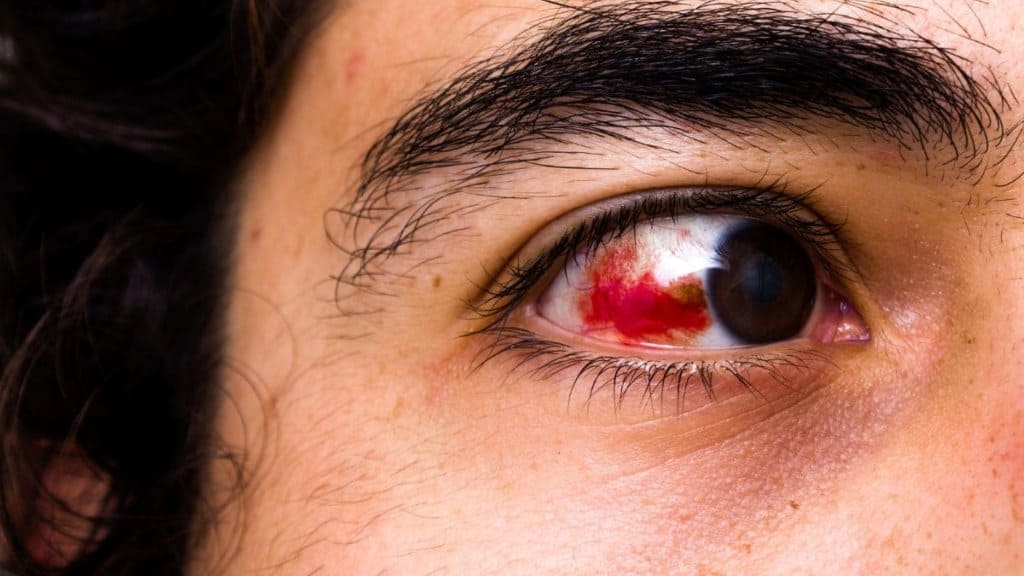 Chảy máu mắt là hiện tượng xuất huyết rò rỉ bên trong mắt