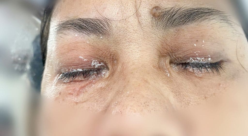 Hình ảnh bệnh nhân bị keo dính chặt 2 mí mắt