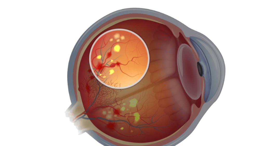 Hình ảnh đáy mắt người mắc bệnh võng mạc tiểu đường