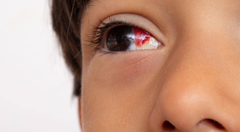 Hình ảnh người bị xuất huyết đáy mắt mức độ nhẹ