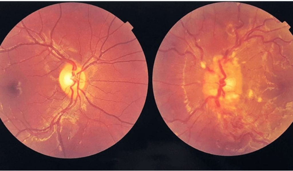Hình ảnh soi đáy mắt bất thường phù gai thị