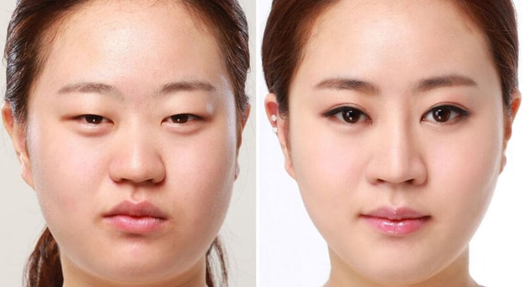 Hình ảnh trước và sau khi cắt mắt hai mí Hàn Quốc