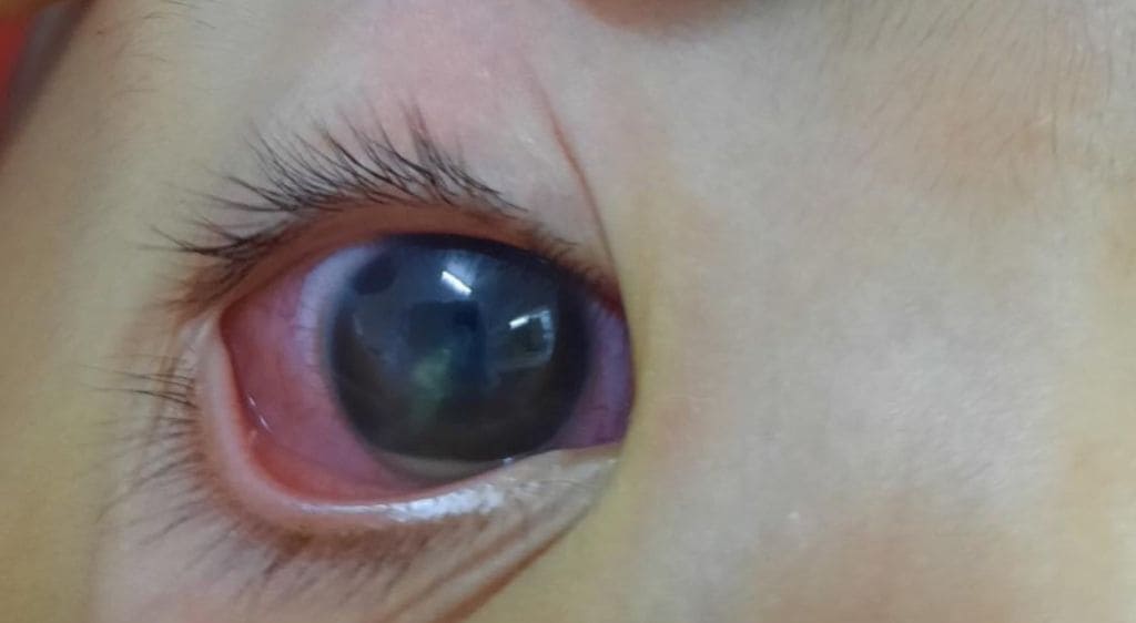 Hình ảnh mắt bị đỏ và tụ máu sau khi bị móng tay chọc vào mắt