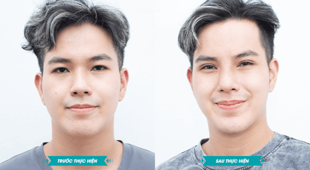 Kỹ thuật cắt mí hở là phương pháp truyền thống và phổ biến nhất hiện nay