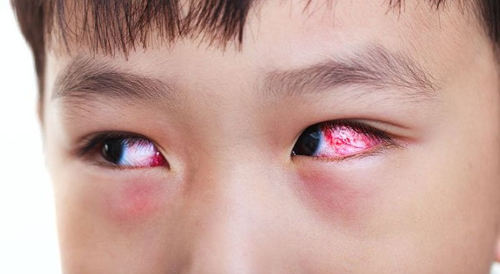 Mắt bé sưng đau, đỏ mắt cần đưa đi viện ngay