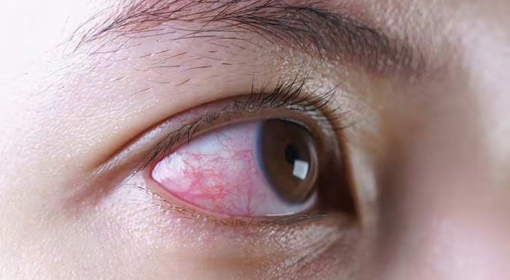 Mắt có nhiều gân máu đỏ do thức khuya, lạm dụng ánh sáng xanh