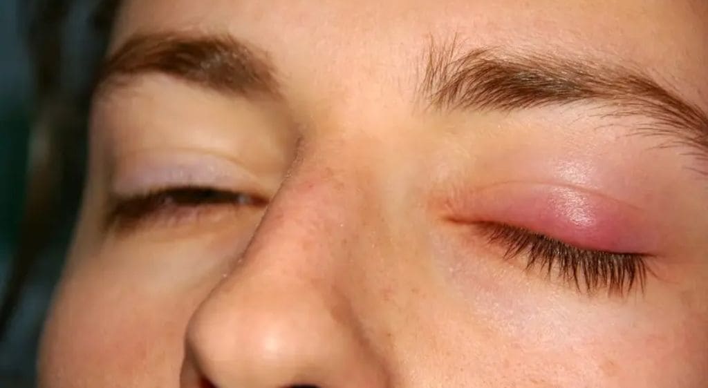 Mắt sưng nề sau khi phẫu thuật cắt mí là biến chứng khá phổ biến