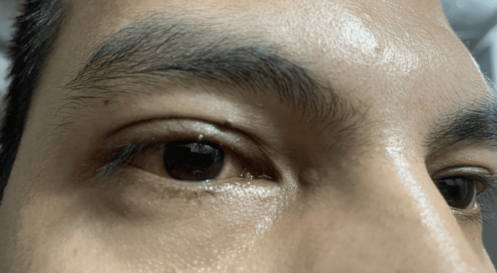 Người mắc bệnh lý võng mạc có thể có dấu hiệu đau hoặc đỏ mắt