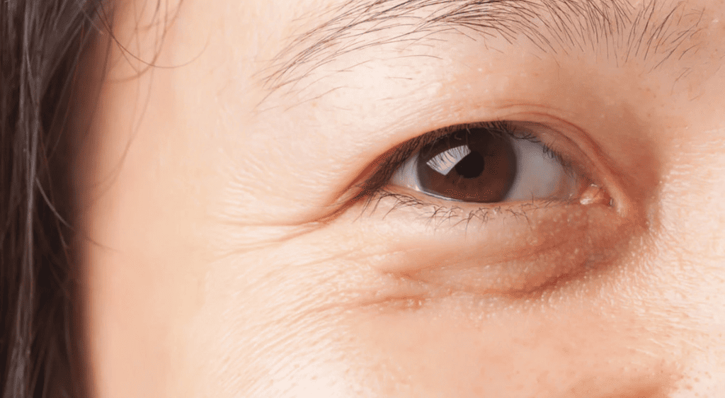 Người sở hữu mí lót nếu cắt mí mắt cười sẽ giúp mắt to và có hồn hơn